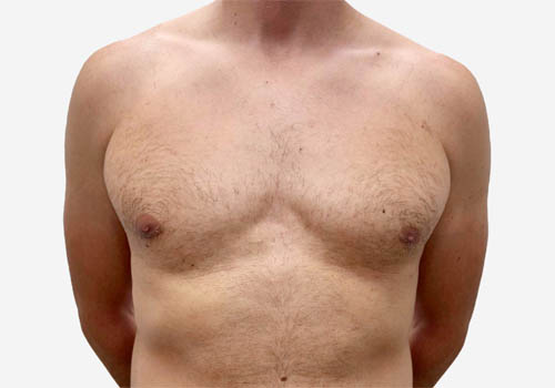 Male Breast Reduction Case 62457 After Photo Male Breast Reduction