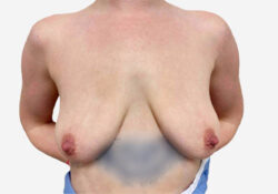 Breast Augmentation