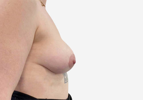 Breast Augmentation