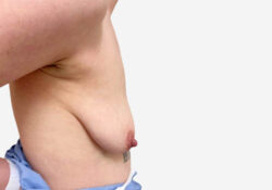 Breast Augmentation