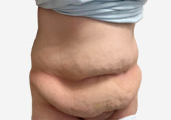 Liposuction