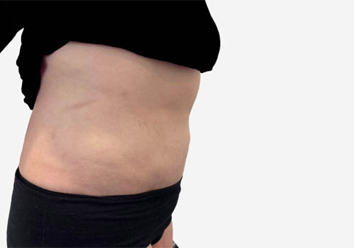 Liposuction
