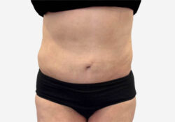 Tummy Tuck