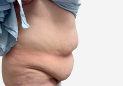 Tummy Tuck