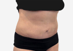 Tummy Tuck