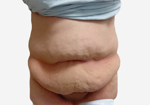Tummy Tuck