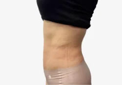 Liposuction