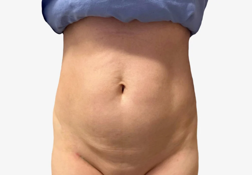 Liposuction