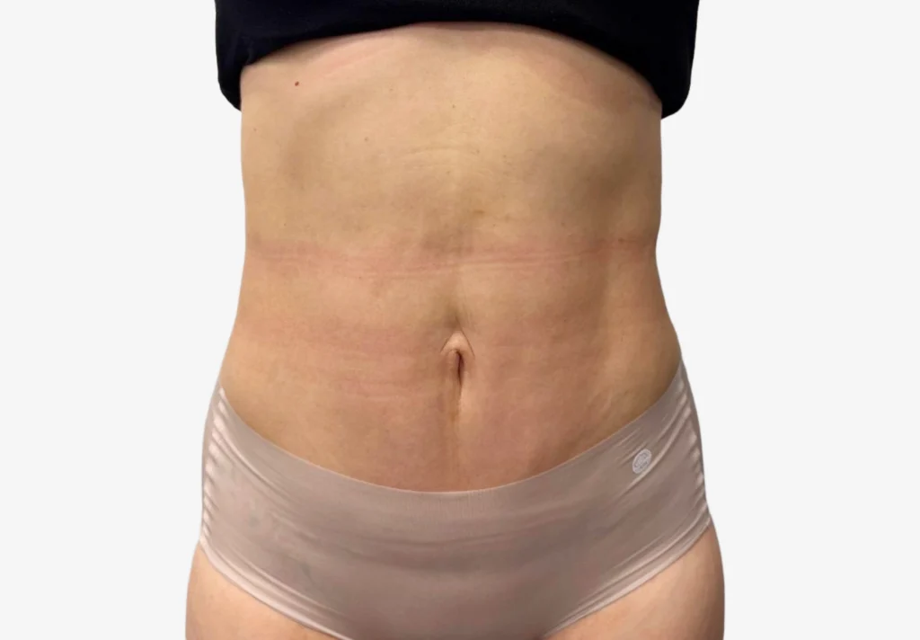 Liposuction