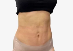 Liposuction