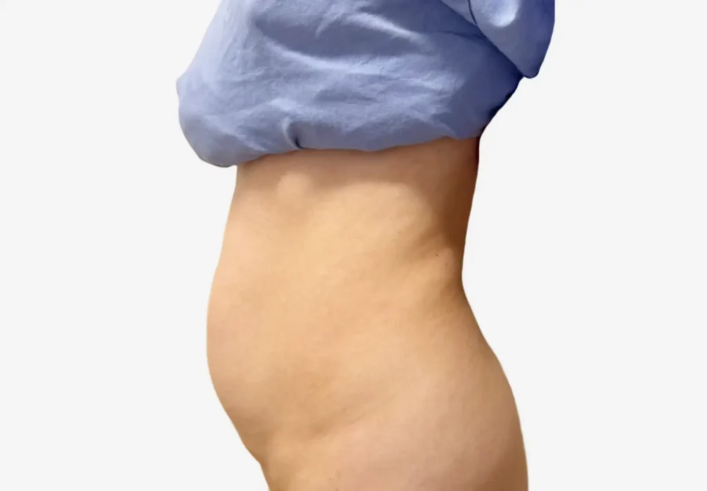 Liposuction
