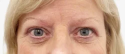 Eyelid Surgery