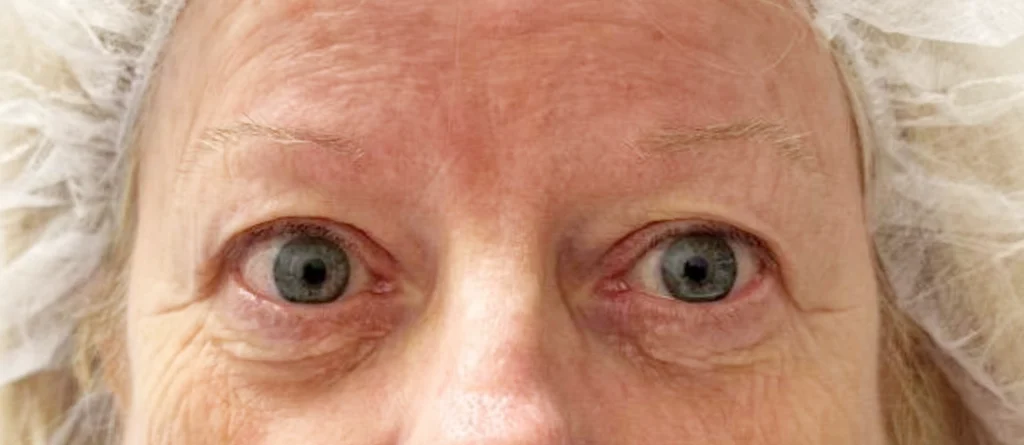 Eyelid Surgery