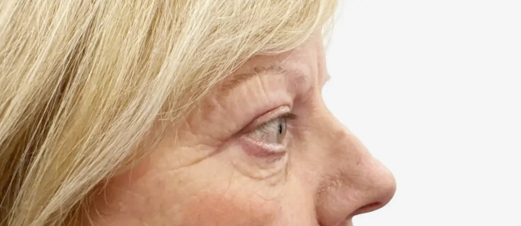 Eyelid Surgery