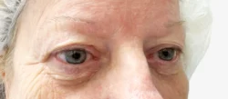 Eyelid Surgery