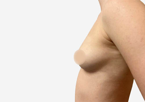 Breast Augmentation
