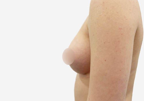 Breast Augmentation