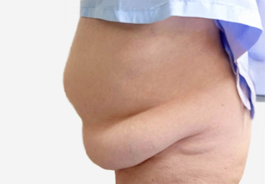 Tummy Tuck