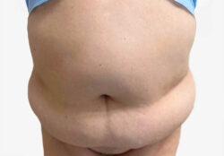 Tummy Tuck