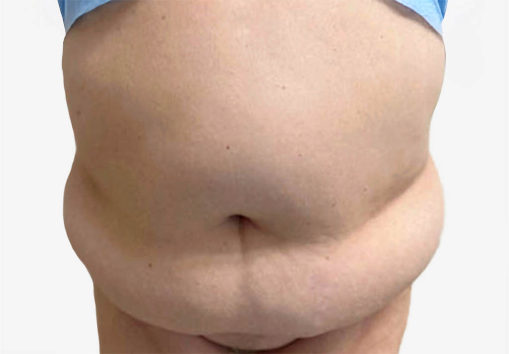 Tummy Tuck