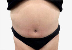 Tummy Tuck