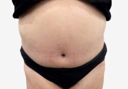 Tummy Tuck