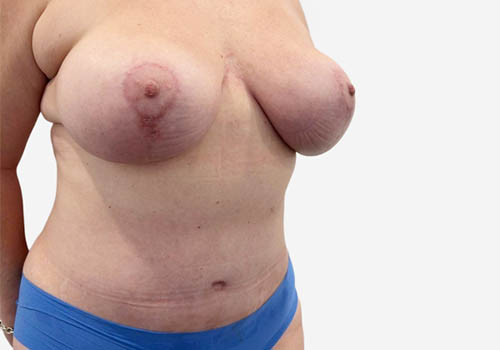 Breast Lift