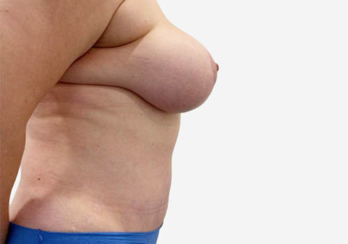 Breast Lift