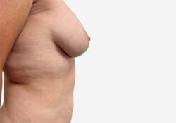 Breast Lift