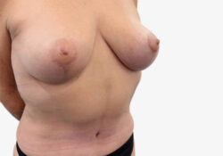 Breast Lift