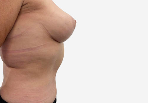 Breast Lift