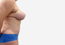 Tummy Tuck