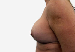 Breast Augmentation