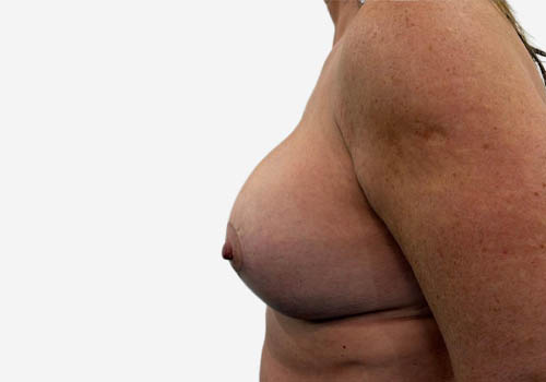 Breast Augmentation