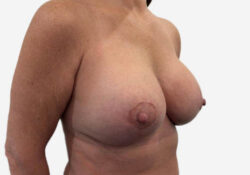 Breast Augmentation