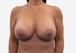 Breast Augmentation