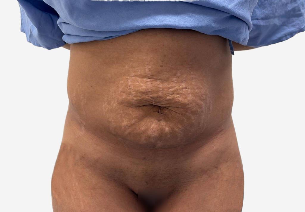 Tummy Tuck
