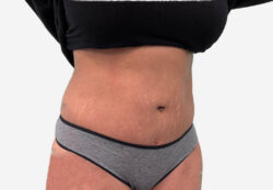 Tummy Tuck