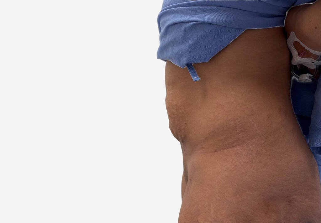 Tummy Tuck