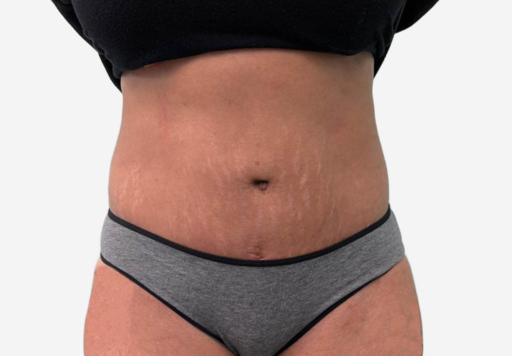 Tummy Tuck