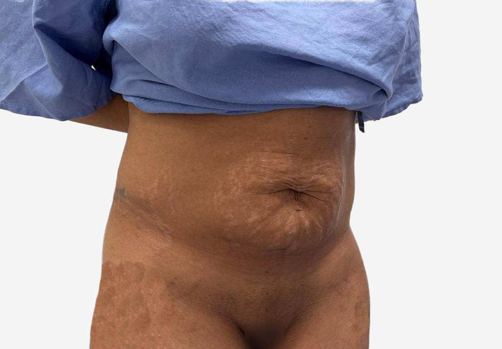 Tummy Tuck