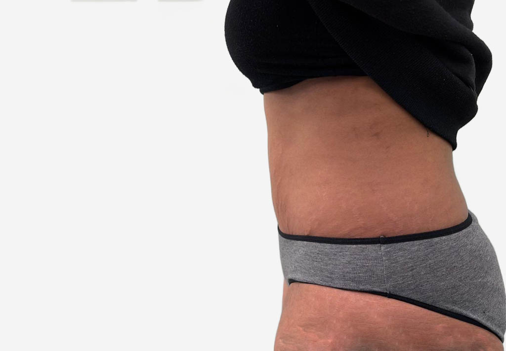 Tummy Tuck