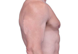 Male Breast Reduction