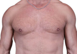 Male Breast Reduction