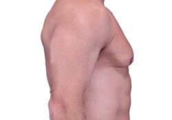 Male Breast Reduction