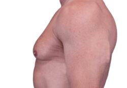 Male Breast Reduction