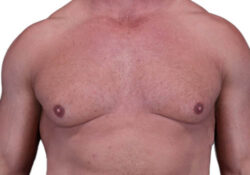 Male Breast Reduction