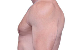 Male Breast Reduction