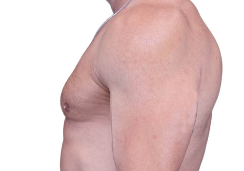 Male Breast Reduction