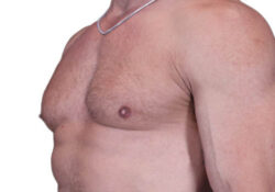 Male Breast Reduction